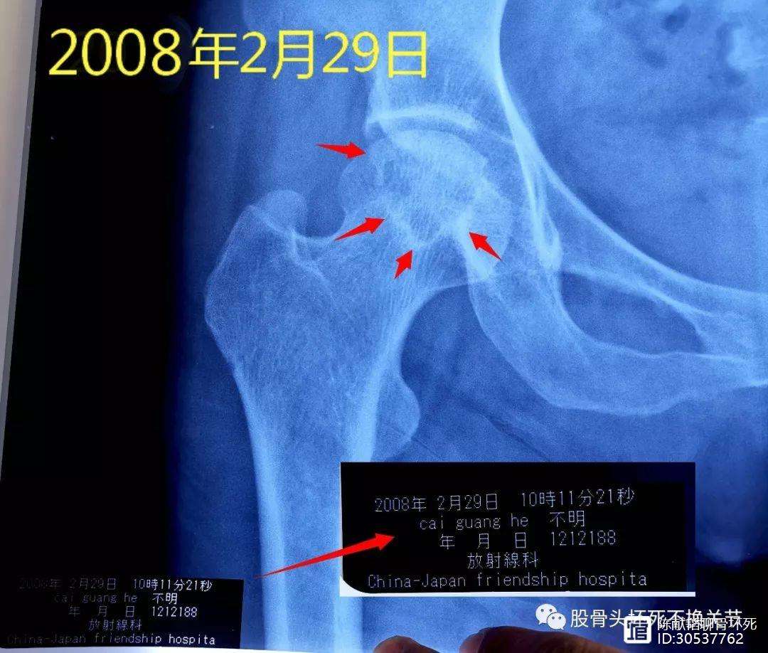 梧州人工骨头医保报销多少(人工骨头医保报销多少比例)